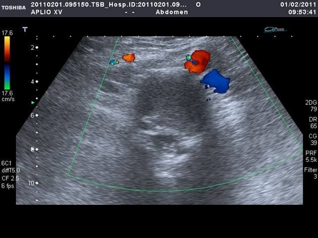 Ecocolodoppler Aorta Addominale