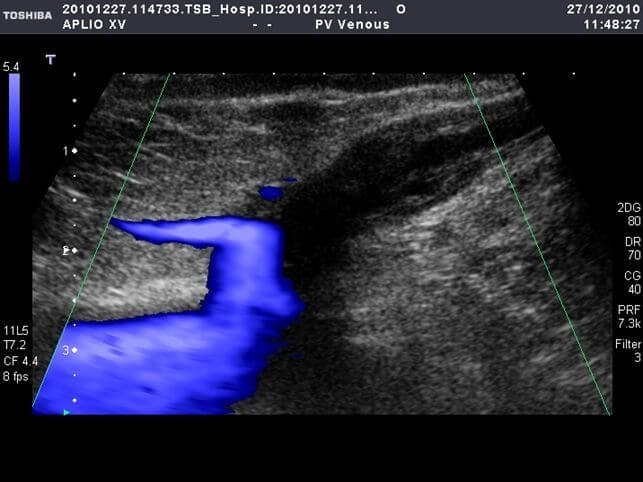 Ecocolordoppler Crosse Safenofemorale