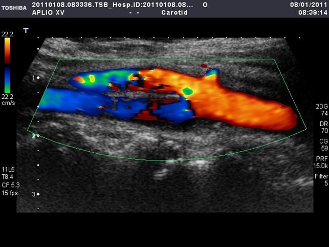 Ecocolordoppler Carotide